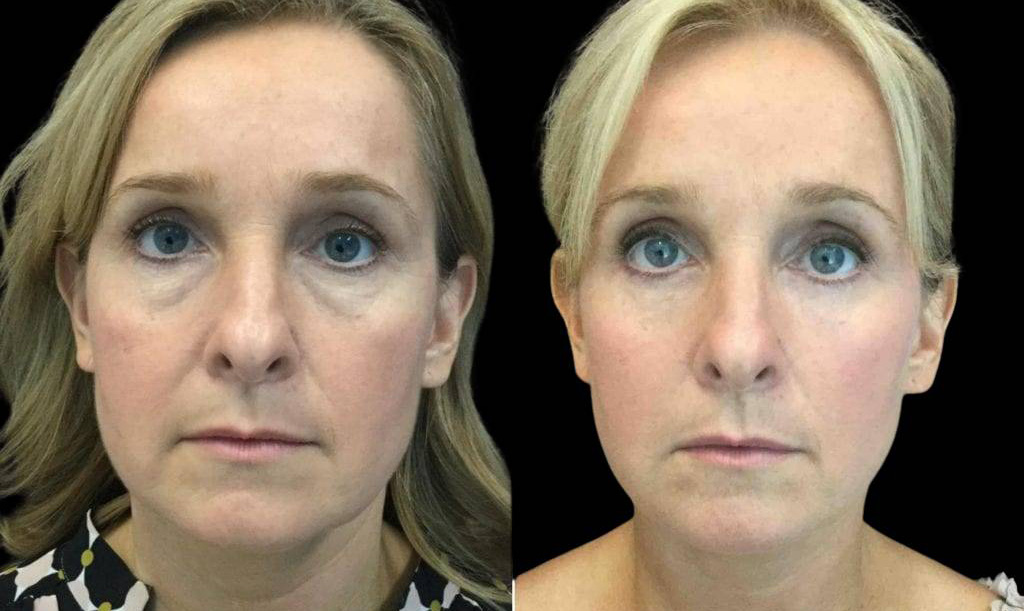46-year-old-female-lower-eyelid-lift-before-and-after-front-view-.jpg