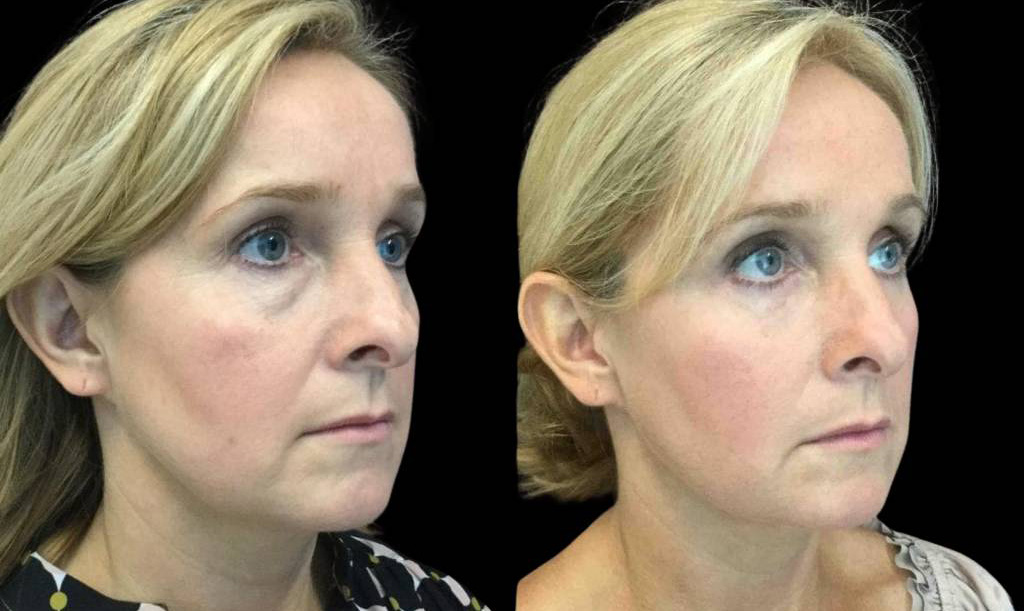46-year-old-female-lower-eyelid-lift-before-and-after-side-view-.jpg