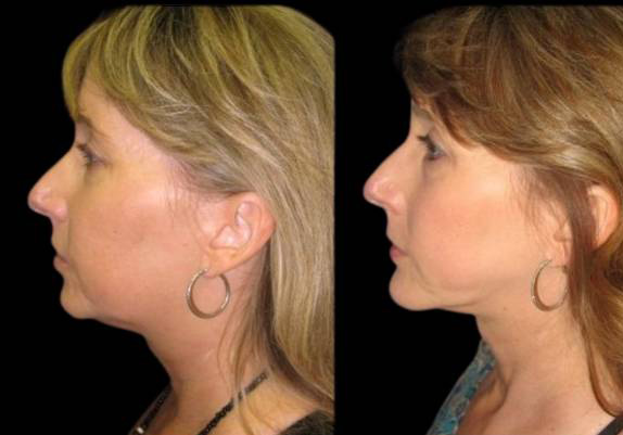 46-year-old-female-neck-liposuction-before-and-after-side-view-6012.jpg