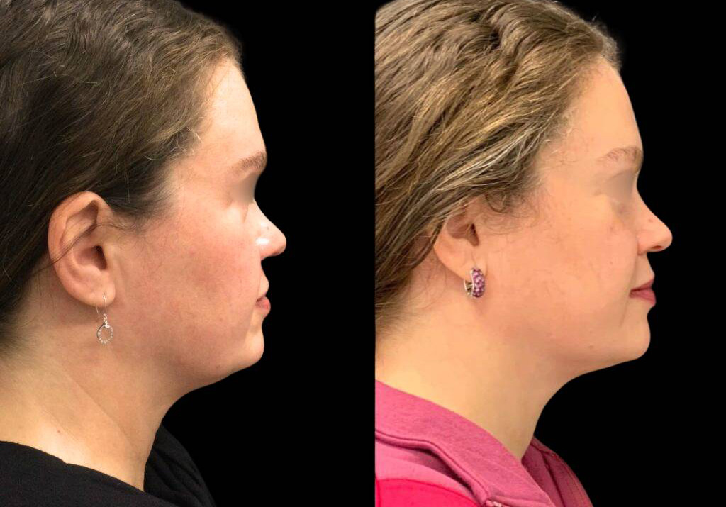 46-year-old-female-neck-liposuction-before-and-after-side-view.jpg