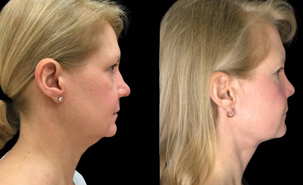 46-year-old-female-necklift-before-and-after-side-view.jpg