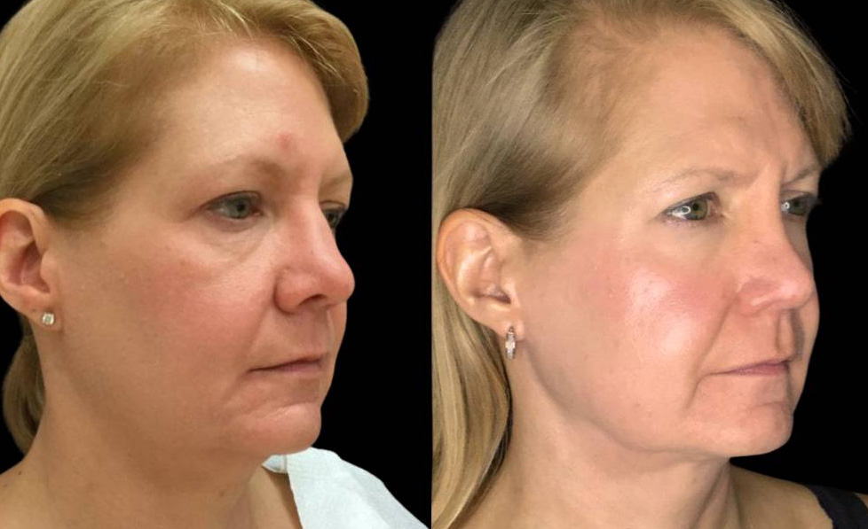 46-year-old-female-necklift-before-and-after-three-quarter-view-23914.jpg