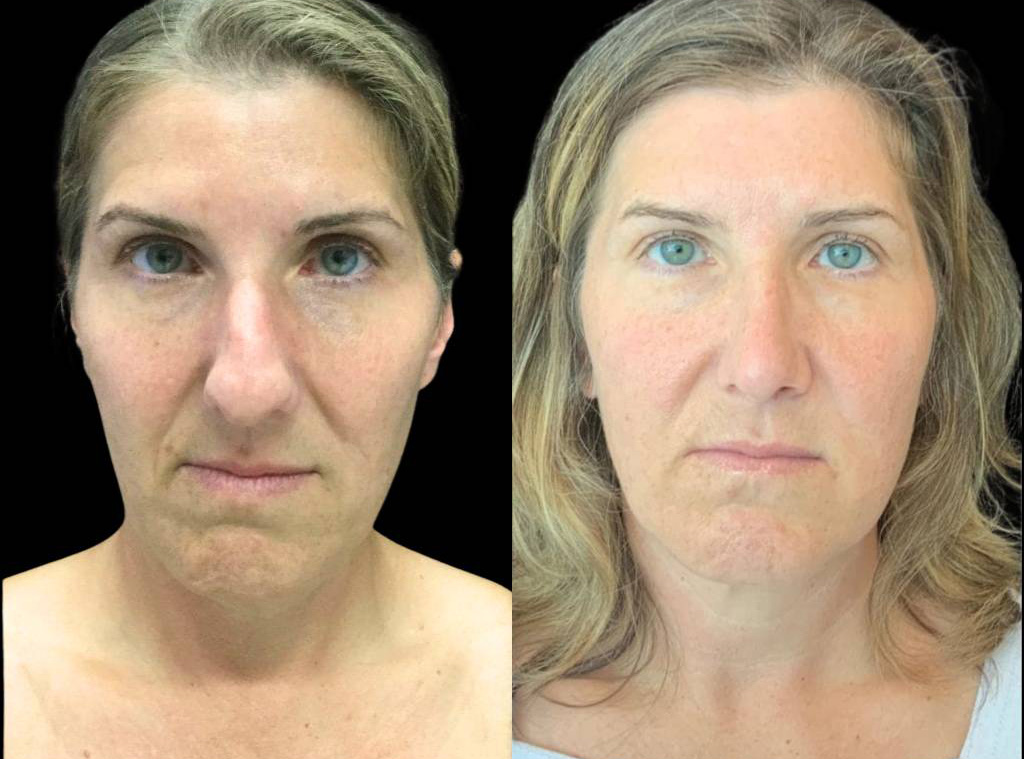 46-year-old-female-rhinoplasty-before-and-after-front-view-.jpg