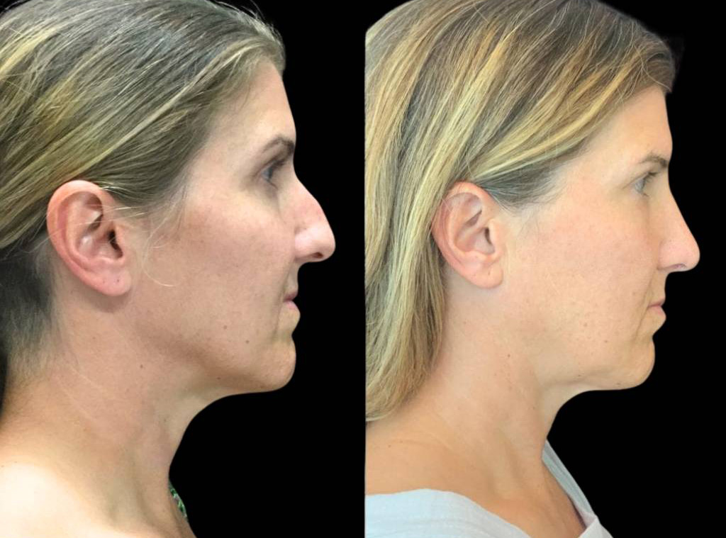 46-year-old-female-rhinoplasty-before-and-after-side-view-.jpg