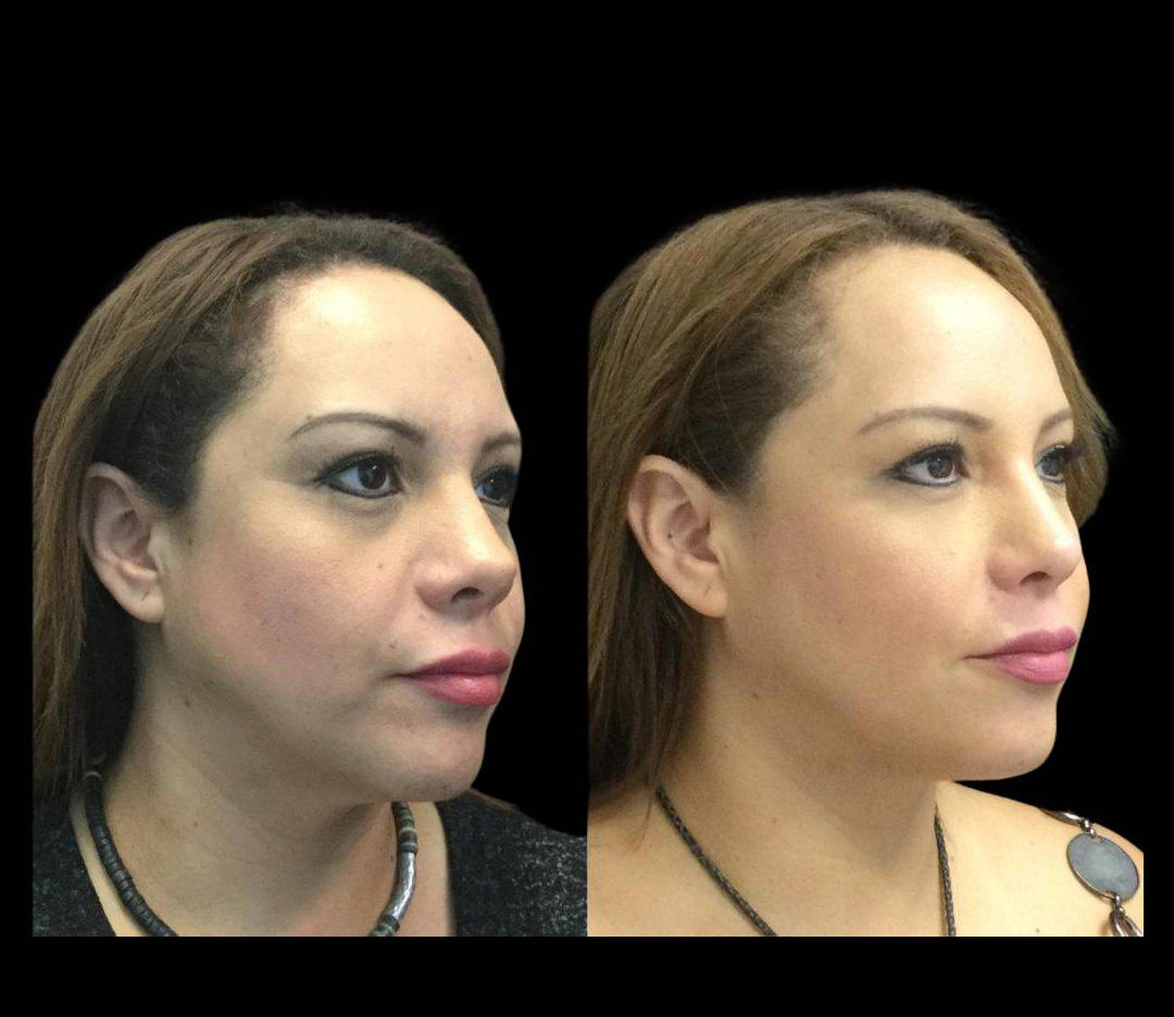 46-year-old-female-ultratherapy-before-and-after-1.jpg
