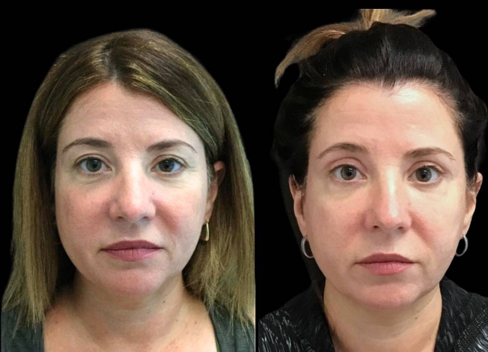 46-year-old-female-upper-eyelid-lift-before-and-after-front-view-31540.jpg