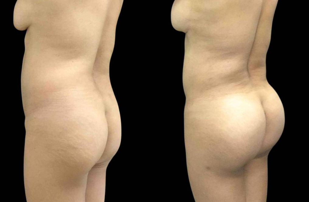 This is a 47-year-old female that has had a brazilian butt lift showing the before and after's side-by-side