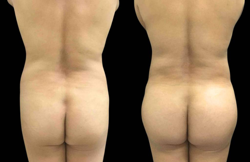 This is a 47-year-old female that has had a brazilian butt lift showing the before and after's side-by-side
