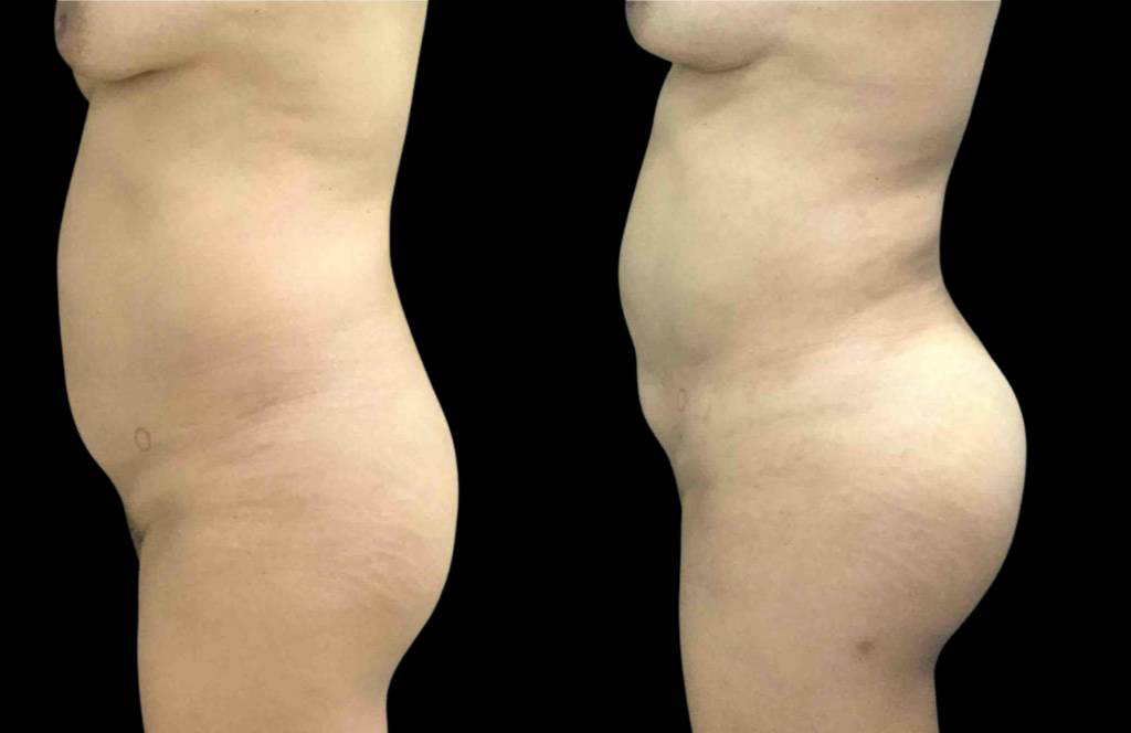 This is a 47-year-old female that has had a brazilian butt lift showing the before and after's side-by-side