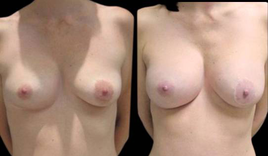 47-year-old-female-breast-implant-exchange-before-and-after-front-view-9555.jpg