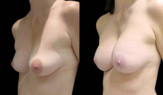 47-year-old-female-breast-implant-exchange-before-and-after-three-quarter-view.jpg