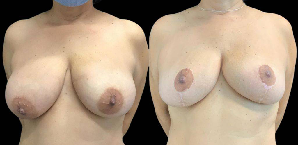 47-year-old-female-breast-reduction-before-and-after-front-view-21706.jpg