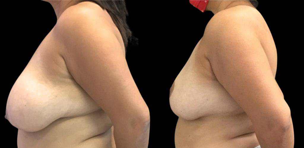 47-year-old-female-breast-reduction-before-and-after-side-view.jpg