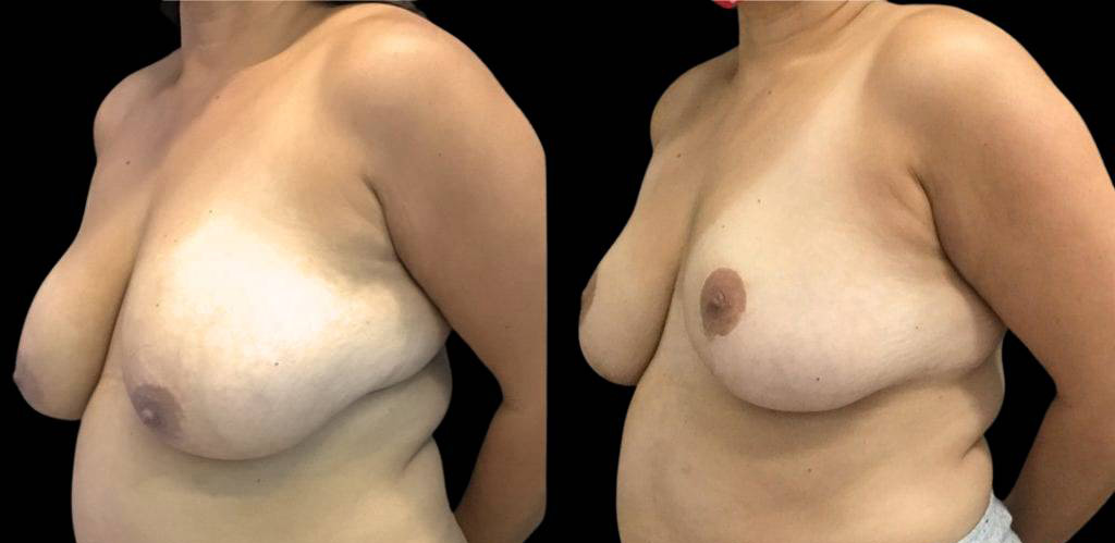 47-year-old-female-breast-reduction-before-and-after-three-quarter-view-22974.jpg