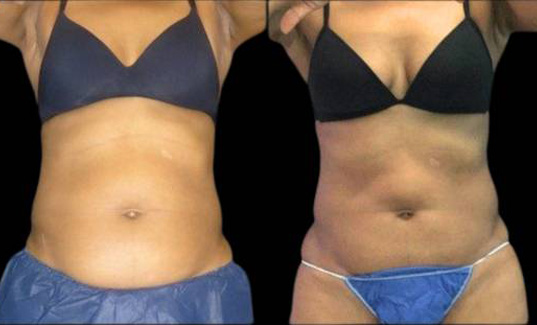 47-year-old-female-coolsculpting-before-and-after-front-view.jpg