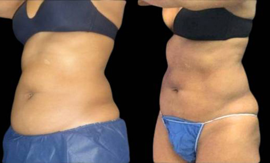47-year-old-female-coolsculpting-before-and-after-three-quarters-view-18764.jpg