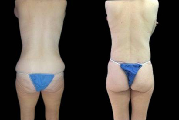 47-year-old-female-lower-body-lift-before-and-after-back-view.jpg