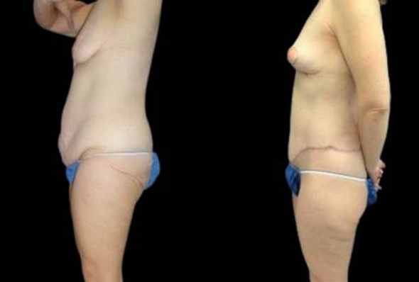 47-year-old-female-lower-body-lift-before-and-after-side-view.jpg
