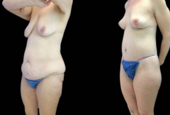 47-year-old-female-lower-body-lift-before-and-after-three-quarter-view.jpg