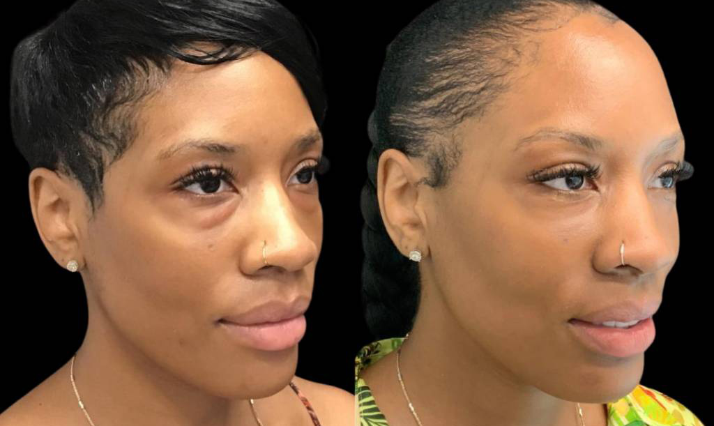 47-year-old-female-lower-eyelid-lift-before-and-after-three-quarter-view.jpg