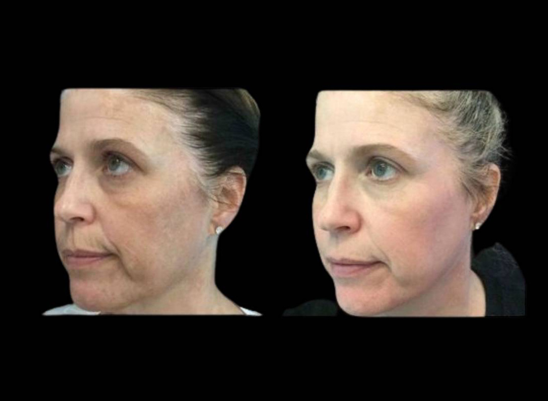 47-year-old-female-melanage-peel-before-and-after-1.jpg