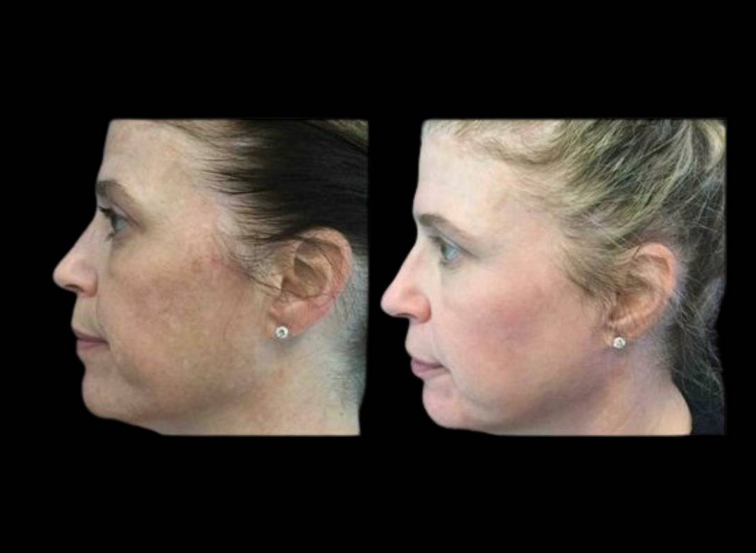 47-year-old-female-melanage-peel-before-and-after-2.jpg