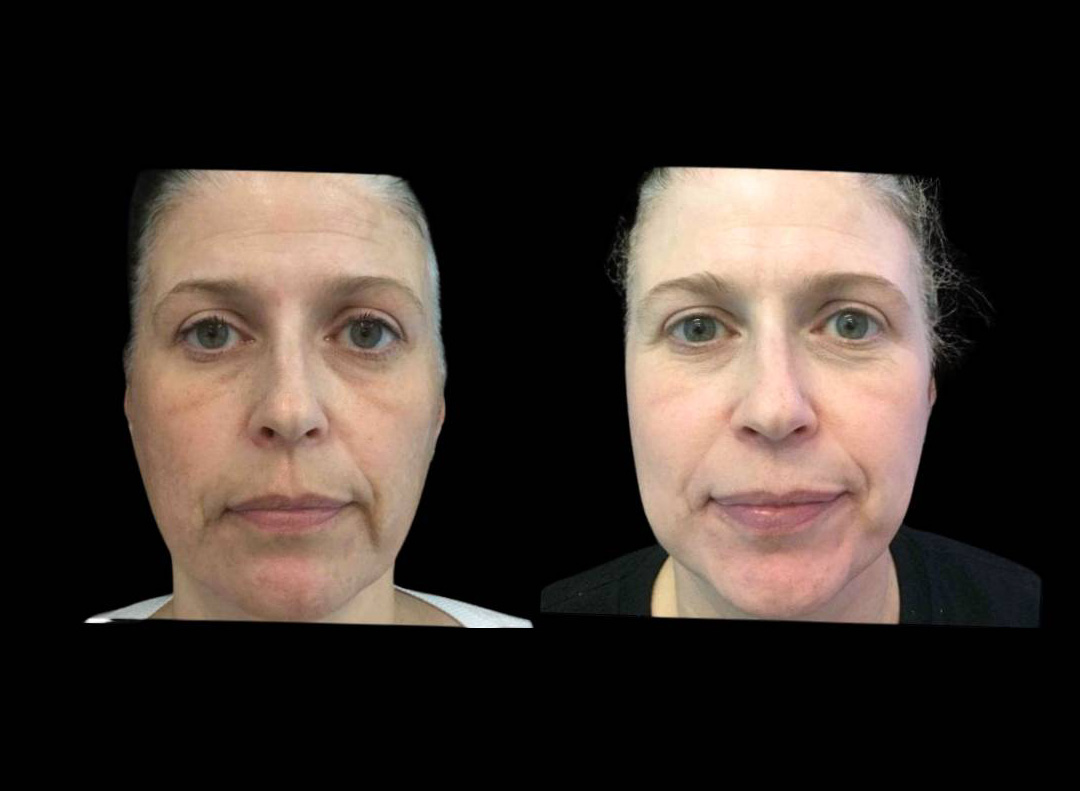 47-year-old-female-melanage-peel-before-and-after.jpg