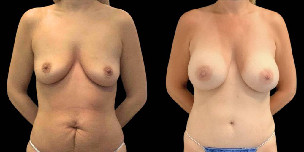 This is a 47-year-old female that has had a mommy makeover showing the before and after's side-by-side