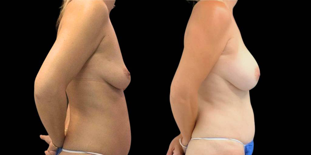 This is a 47-year-old female that has had a mommy makeover showing the before and after's side-by-side