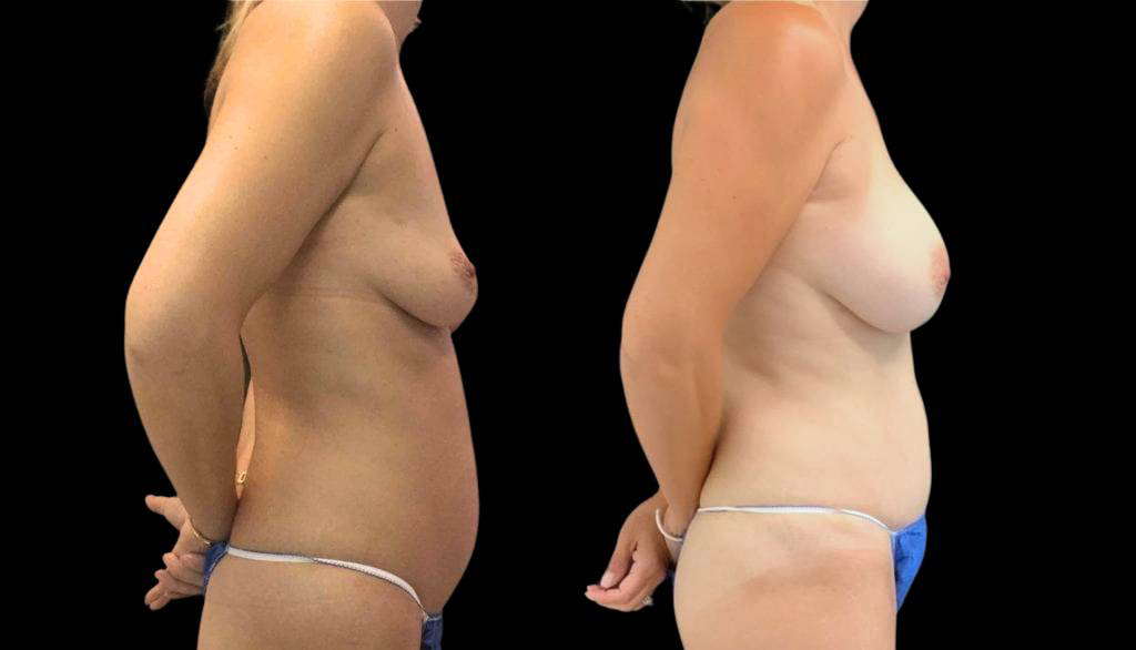 47-year-old-female-mommy-makeover-body-before-and-after-side-view.jpg