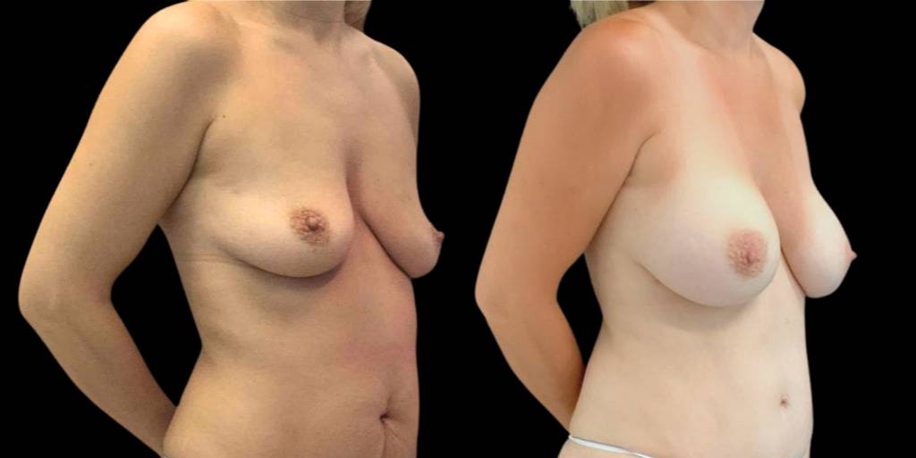 This is a 47-year-old female that has had a mommy makeover showing the before and after's side-by-side