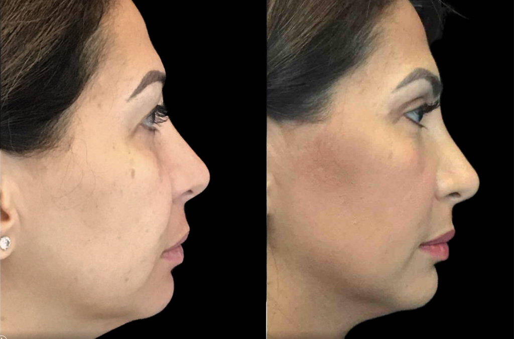 47-year-old-female-upper-and-lower-eyelid-lift-before-and-after-1.jpg
