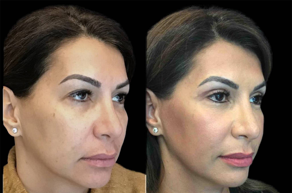 47-year-old-female-upper-and-lower-eyelid-lift-before-and-after-3.jpg