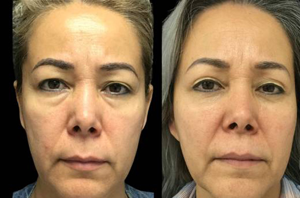 47-year-old-female-upper-and-lower-eyelid-lift-before-and-after-front-view-25520.jpg