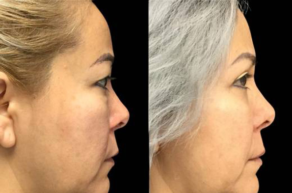 47-year-old-female-upper-and-lower-eyelid-lift-before-and-after-side-view.jpg