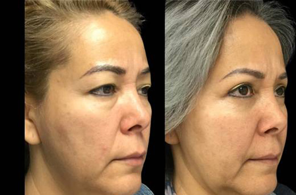 47-year-old-female-upper-and-lower-eyelid-lift-before-and-after-three-quarter-view.jpg