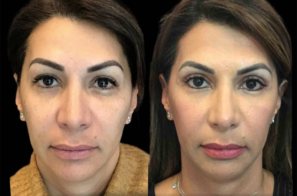 47-year-old-female-upper-and-lower-eyelid-lift-before-and-after.jpg