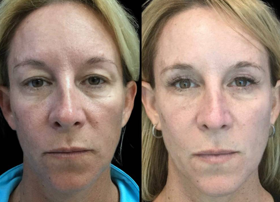 47-year-old-female-upper-eyelid-lift-before-and-after-front-view-25287.jpg
