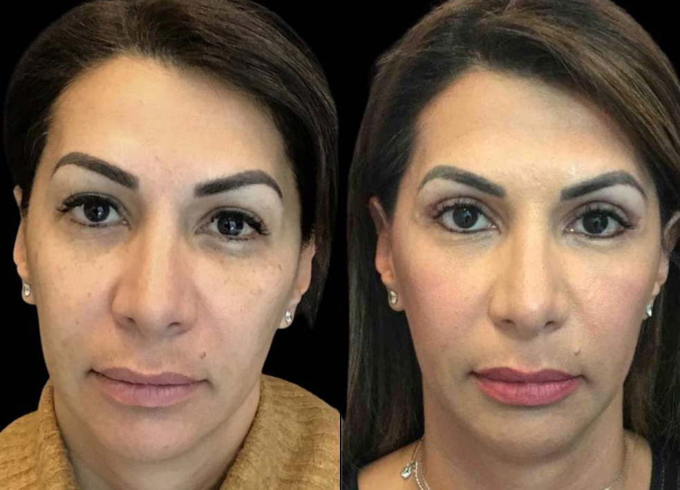47-year-old-female-upper-eyelid-lift-before-and-after-front-view-28579.jpg