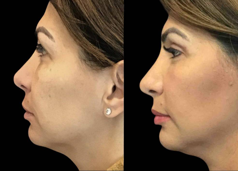 47-year-old-female-upper-eyelid-lift-before-and-after-side-view.jpg