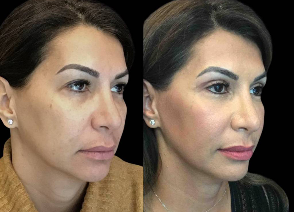 47-year-old-female-upper-eyelid-lift-before-and-after-three-quarter-view-2.jpg