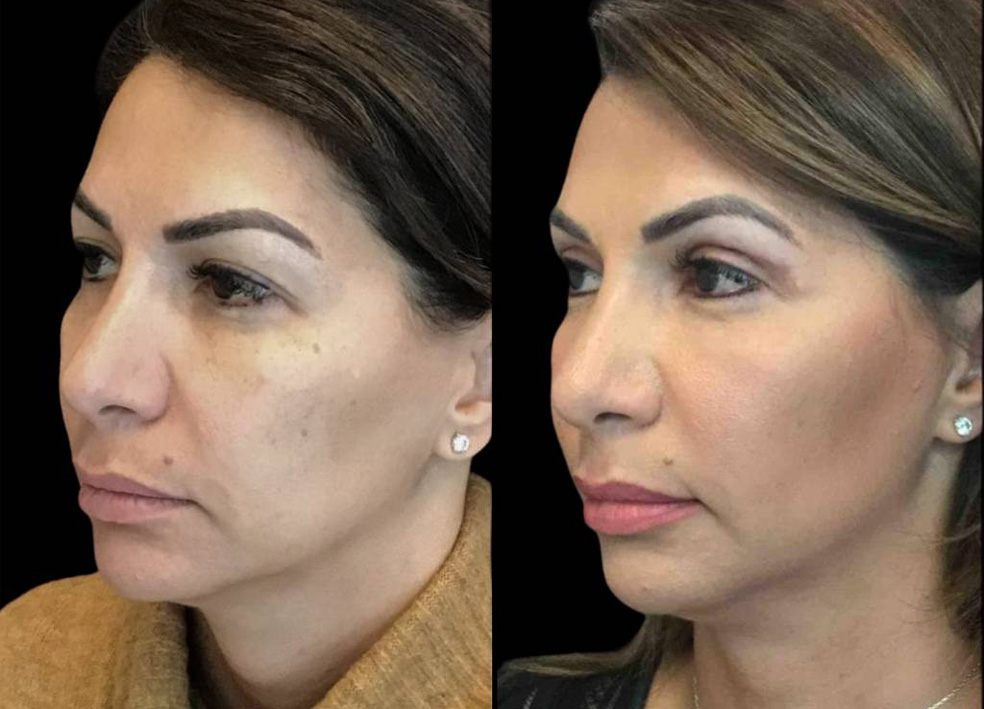 47-year-old-female-upper-eyelid-lift-before-and-after-three-quarter-view-3.jpg