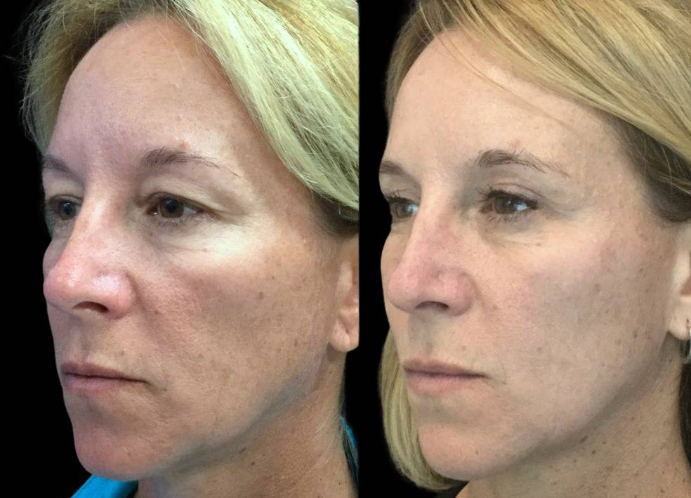 47-year-old-female-upper-eyelid-lift-before-and-after-three-quarter-view.jpg