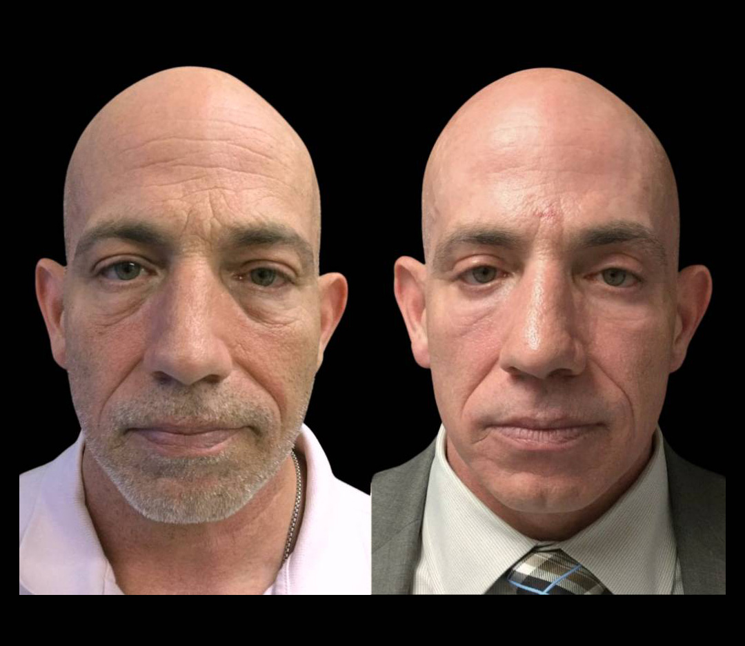 47-year-old-male-fractional-co2-laser-before-and-after-front-view-22330.jpg