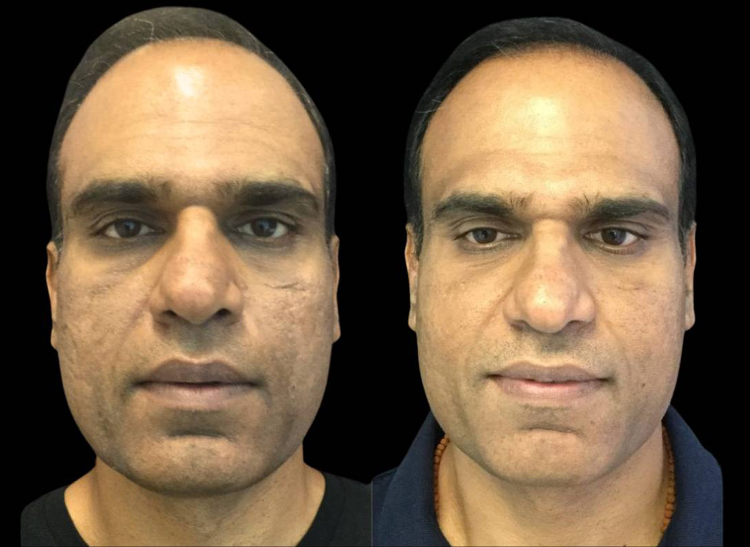 47-year-old-male-microneedling-before-and-after-1.jpg