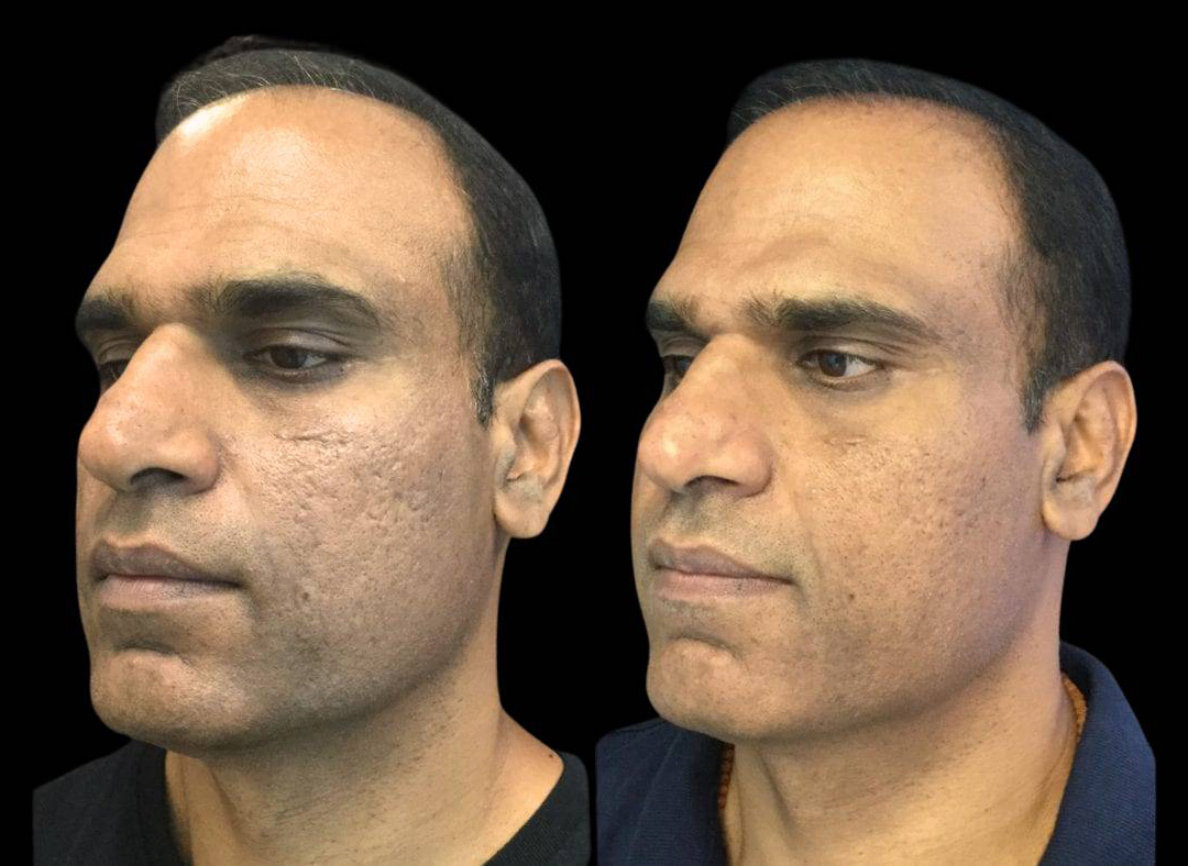 47-year-old-male-microneedling-before-and-after.jpg