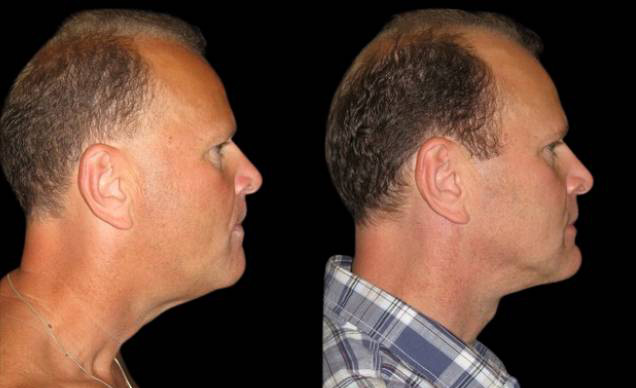47-year-old-male-necklift-before-and-after-side-view.jpg