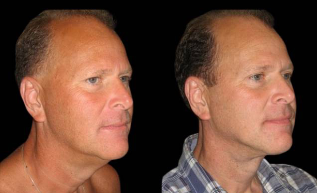 47-year-old-male-necklift-before-and-after-three-quarter-view-10188.jpg