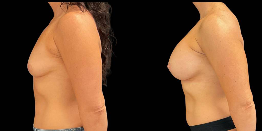 47-yr-old-female-breast-augmentation-before-and-after-left-view