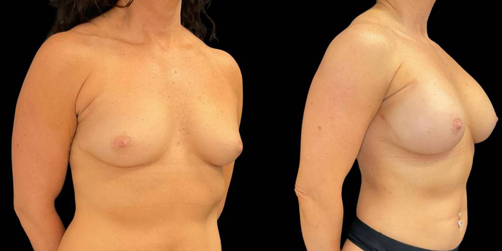 47-yr-old-female-breast-augmentation-before-and-after-left-view